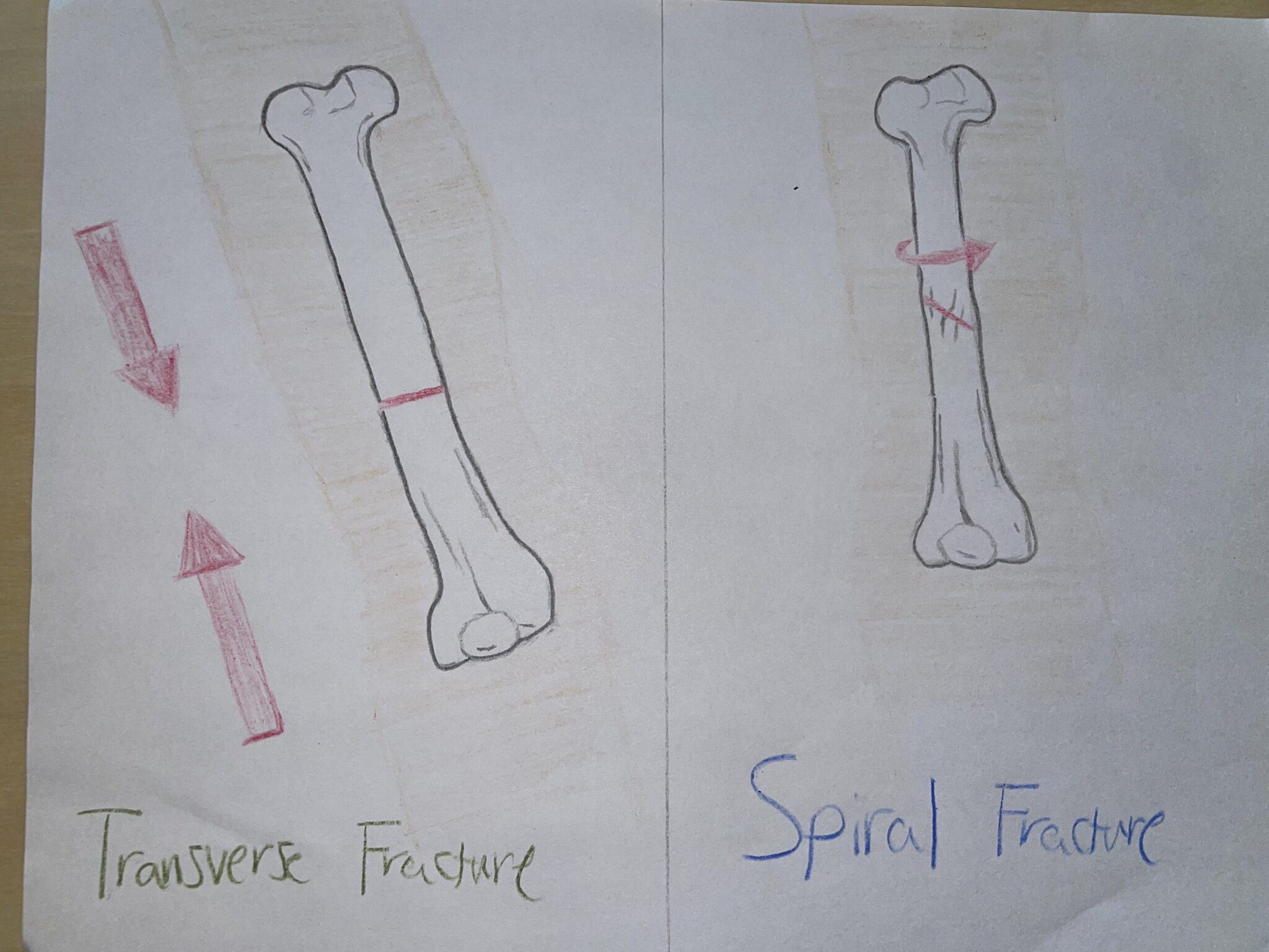 Classifying Fractures Human STEAM