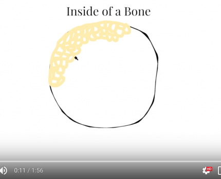 Osteoporosis – The Breakdown of Healthy Bone (Miranda Lally)