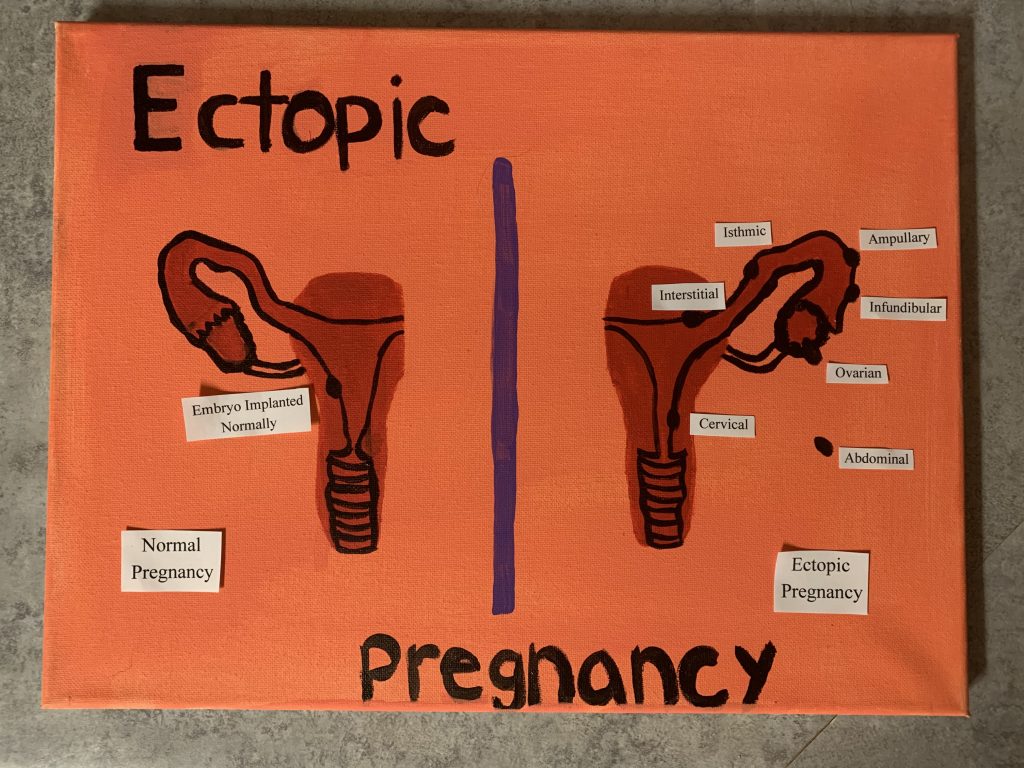 Ectopic vs Normal Pregnancy Painting – Human STEAM