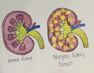 Polycystic Kidney Disease 