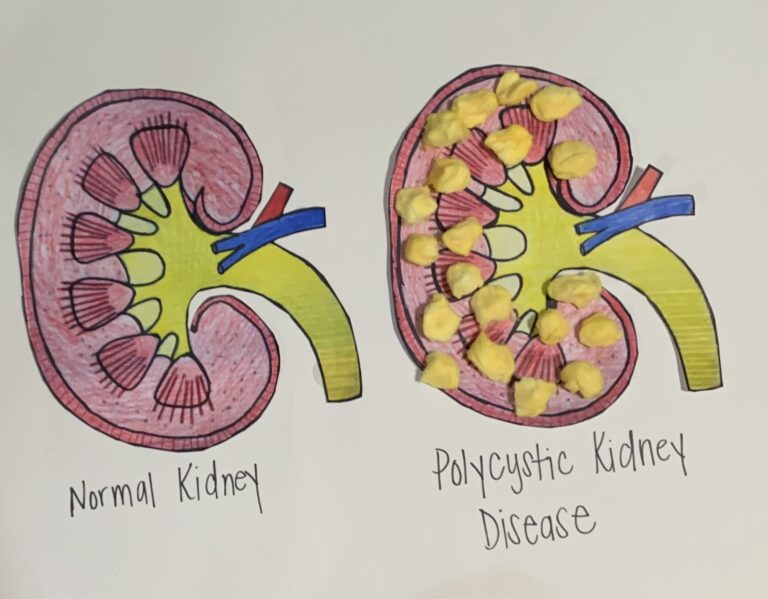 polycystic-kidney-disease-human-steam