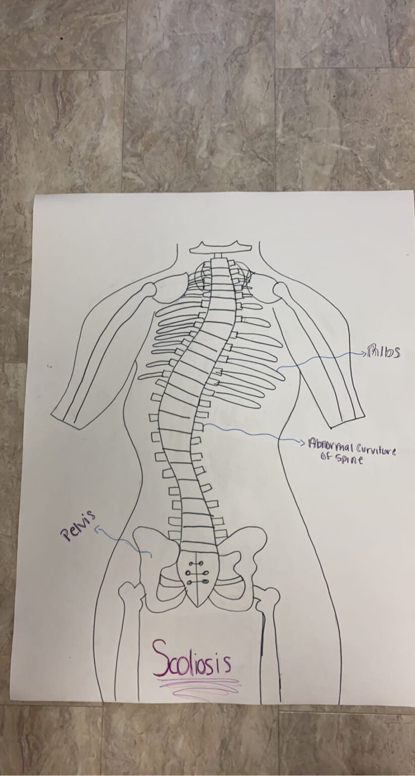 Scoliosis Human STEAM