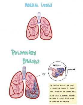 Pulmonary Fibrosis – Human STEAM