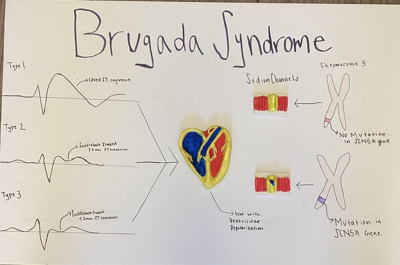 Brugada Syndrome – Human STEAM