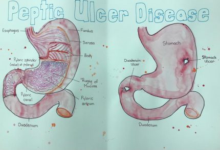 Peptic Ulcer Disease – Human STEAM