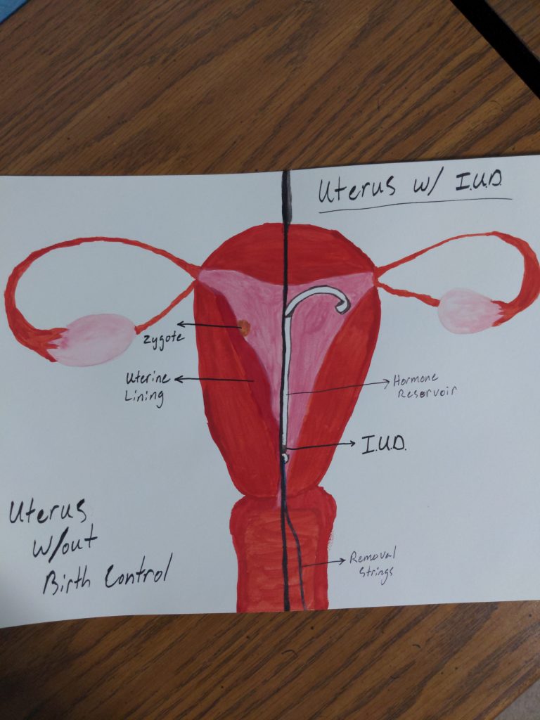 Hormonal Intrauterine Devices (IUD) Functionality and Mechanisms ...