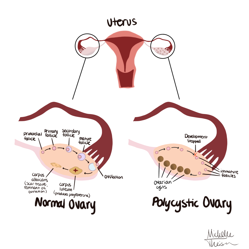 Polysistic ovary digital drawing