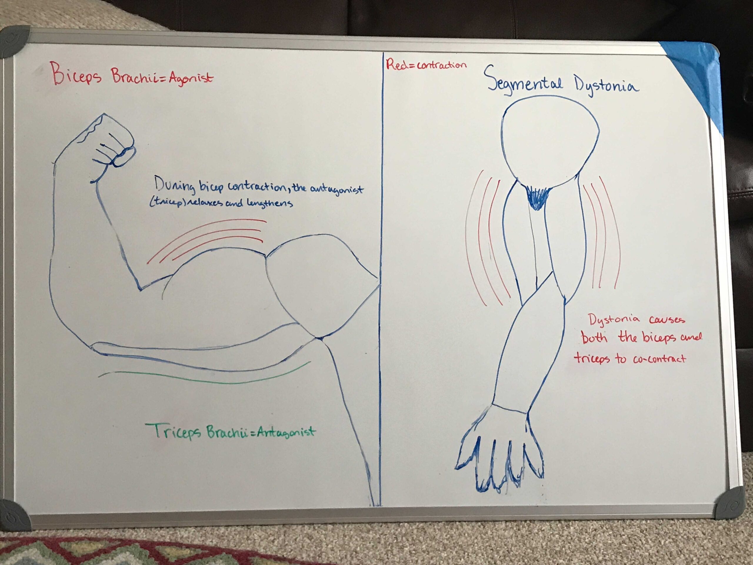 Dystonia compared to normal muscle contraction