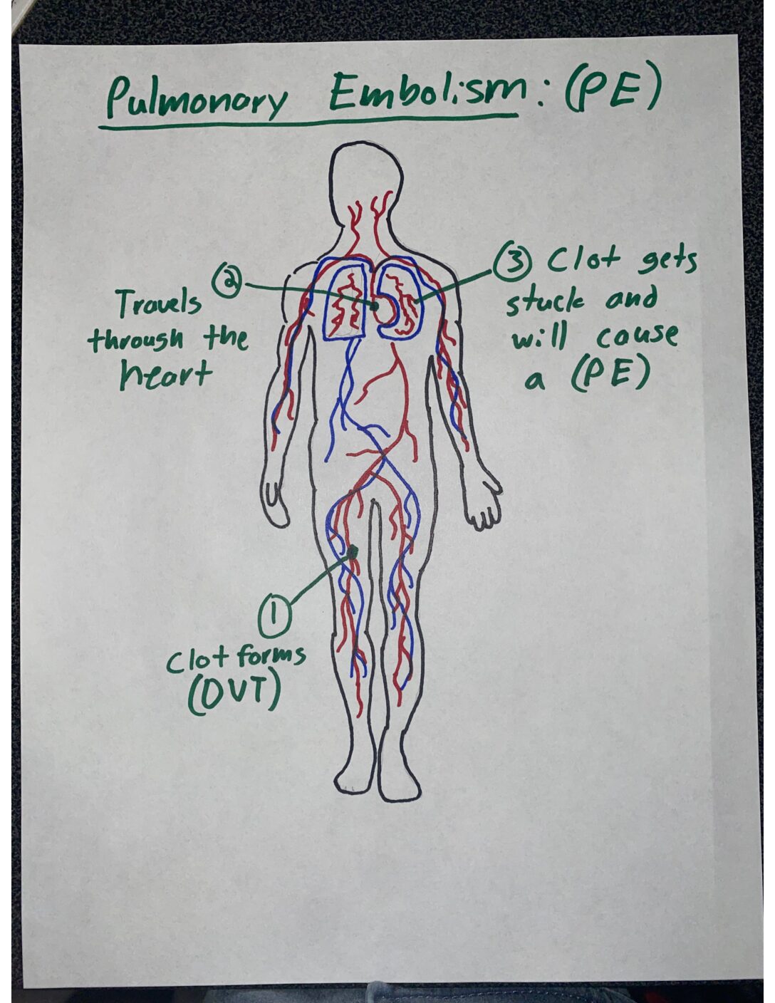 Pulmonary Embolism Flow Chart