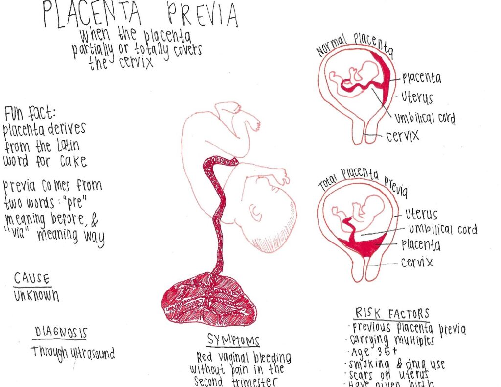 Placenta Previa Human STEAM