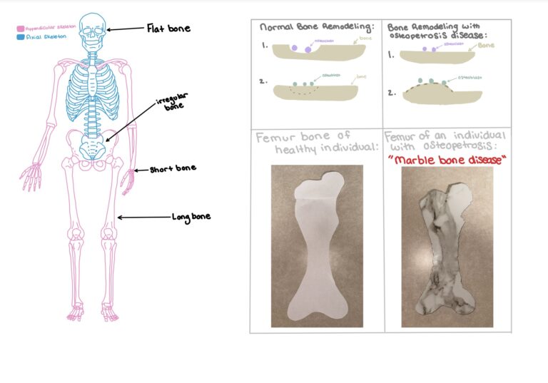 the-marble-bone-disease-human-steam