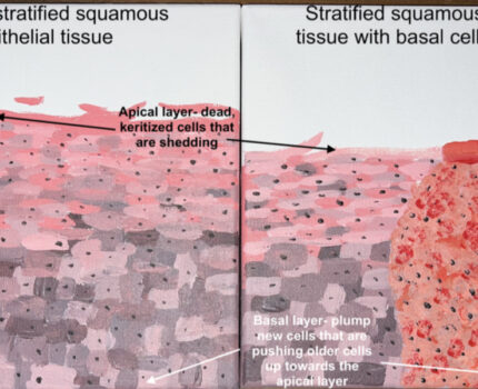 Stratified Squamous Epithelial Patchwork- Healthy versus diseased