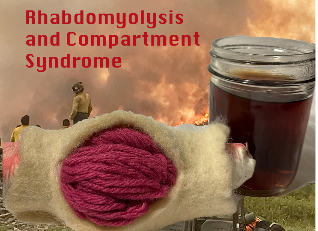 rhabdomyolysis and compartment syndrome