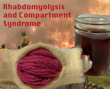 Rhabdomyolysis and Compartment Syndrome