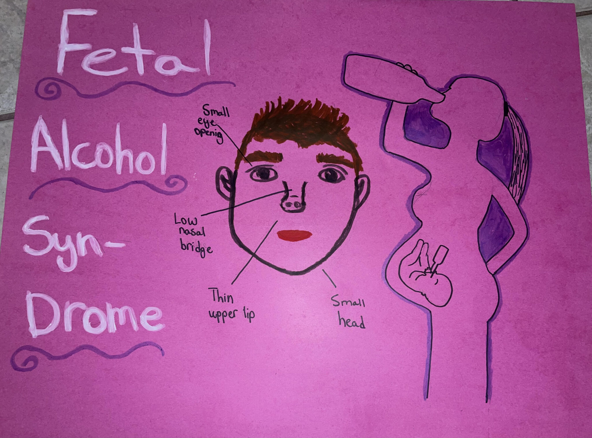Fetal Alcohol Syndrome Human Steam 9545