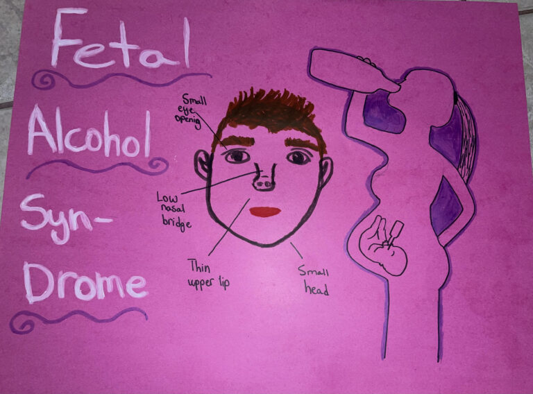 fetal-alcohol-syndrome-human-steam