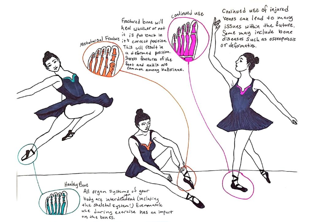 Bone Fractures In Ballerinas – Human STEAM