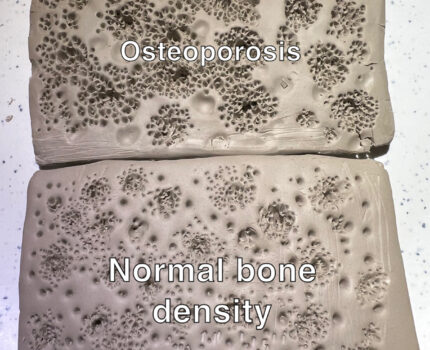 The Effects of Osteoporosis