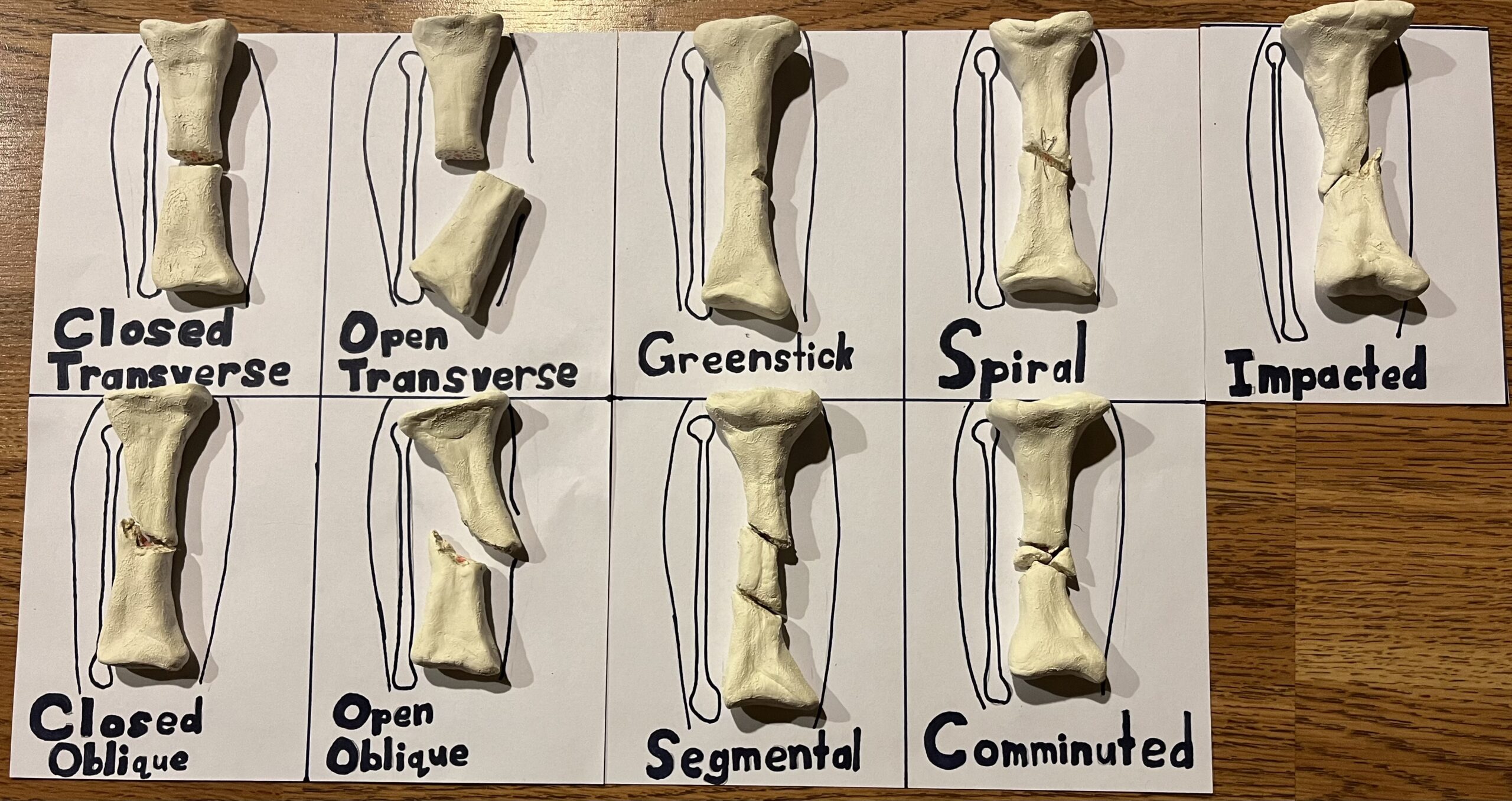 Classification of Tibia Fractures