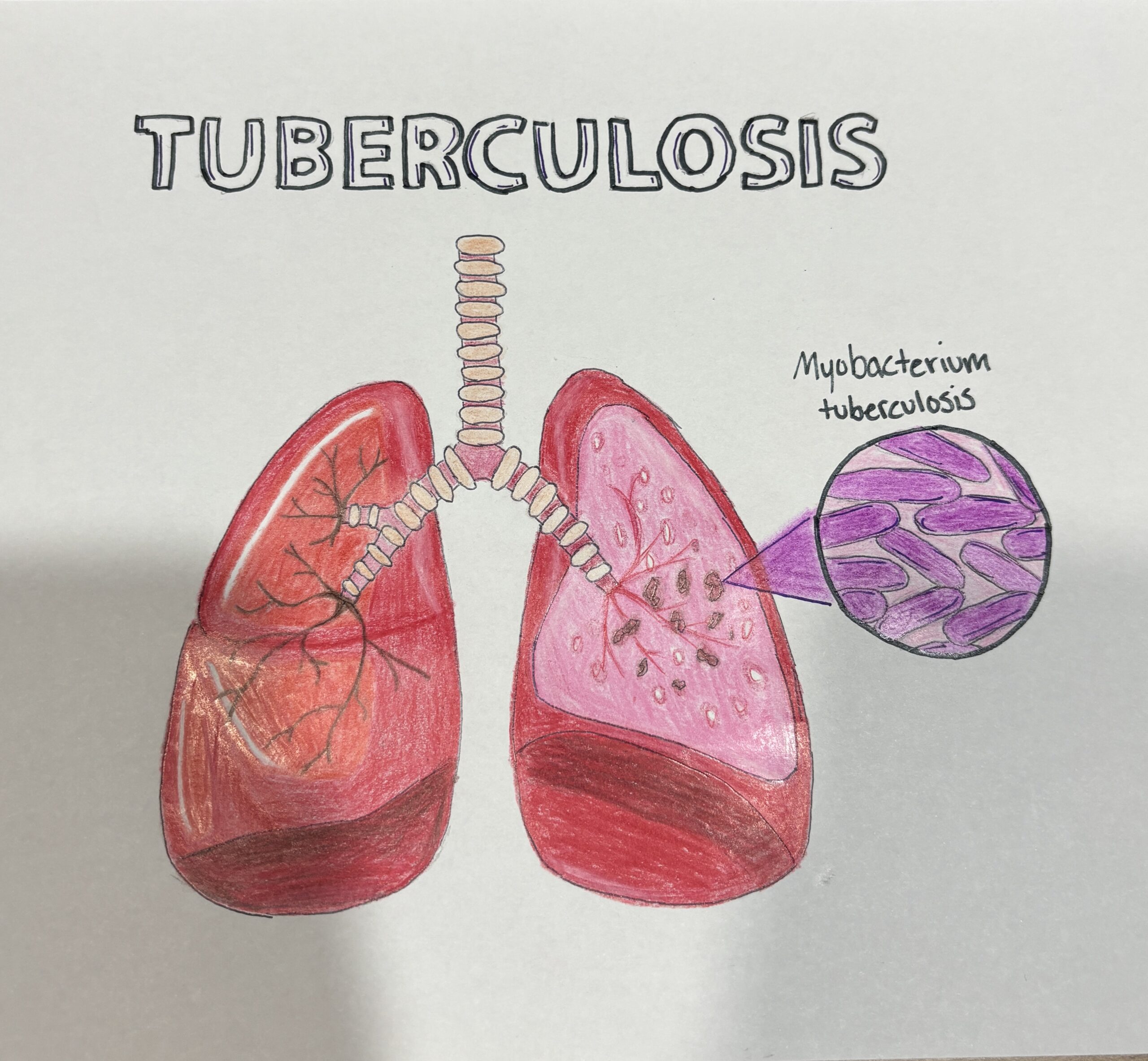 Tuberculosis by Amelie Collard