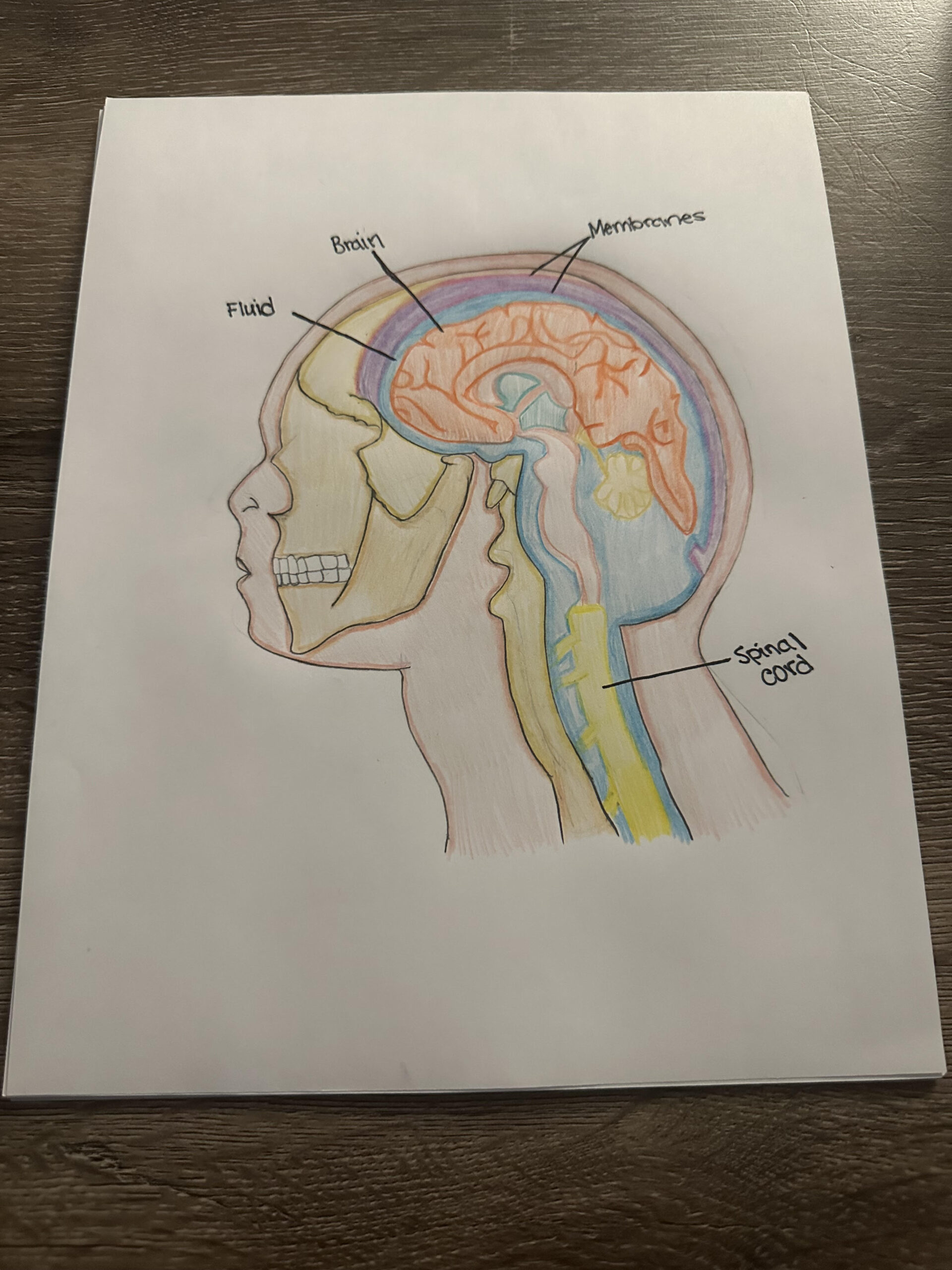 Bacterial Meningitis – Human STEAM