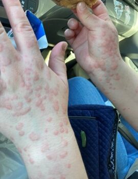 Essential (Acquired) Cold Urticaria and the Immune System