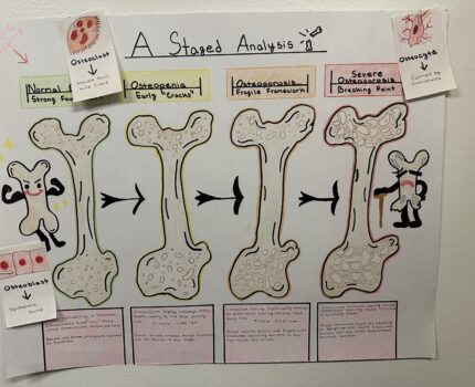 The Progressive Stages of Osteoporosis