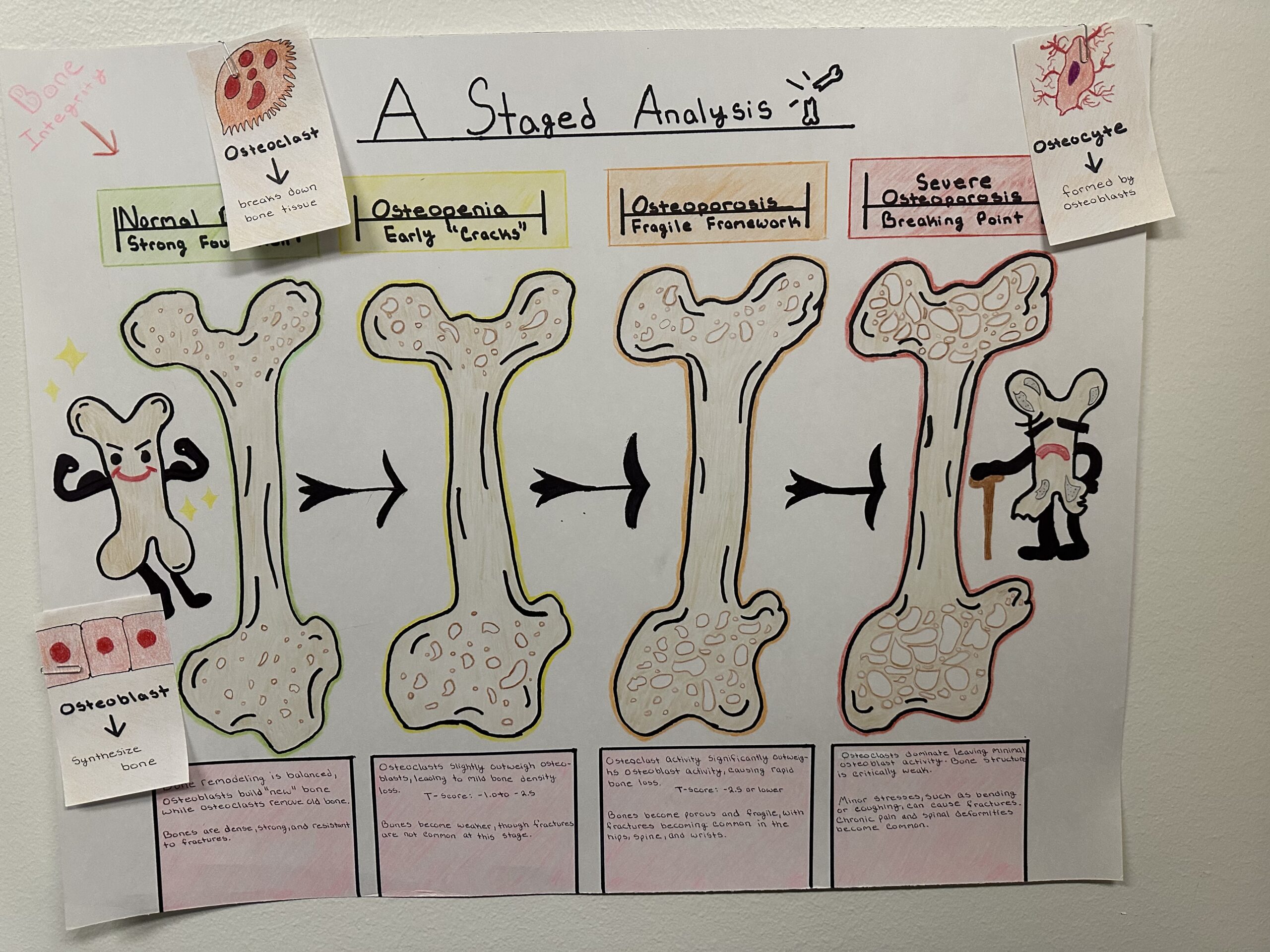 The Progressive Stages of Osteoporosis