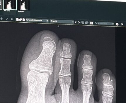 Story of Broken Bone and Repair