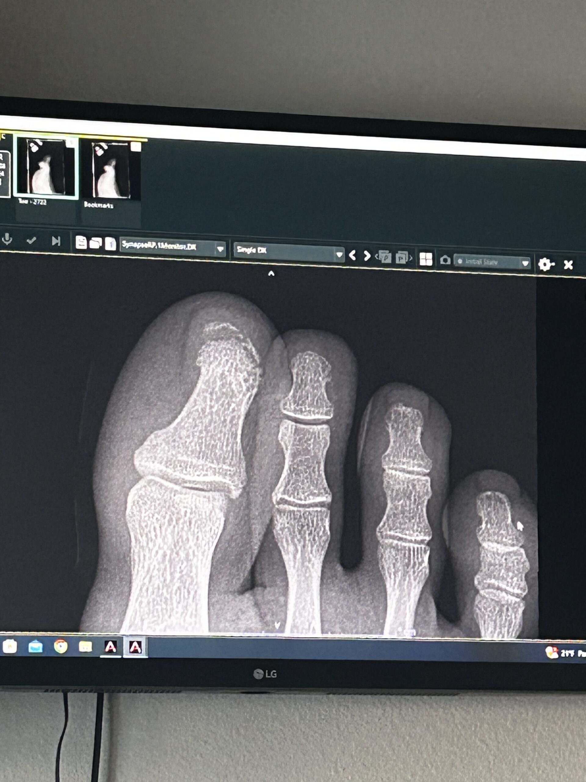 Story of Broken Bone and Repair