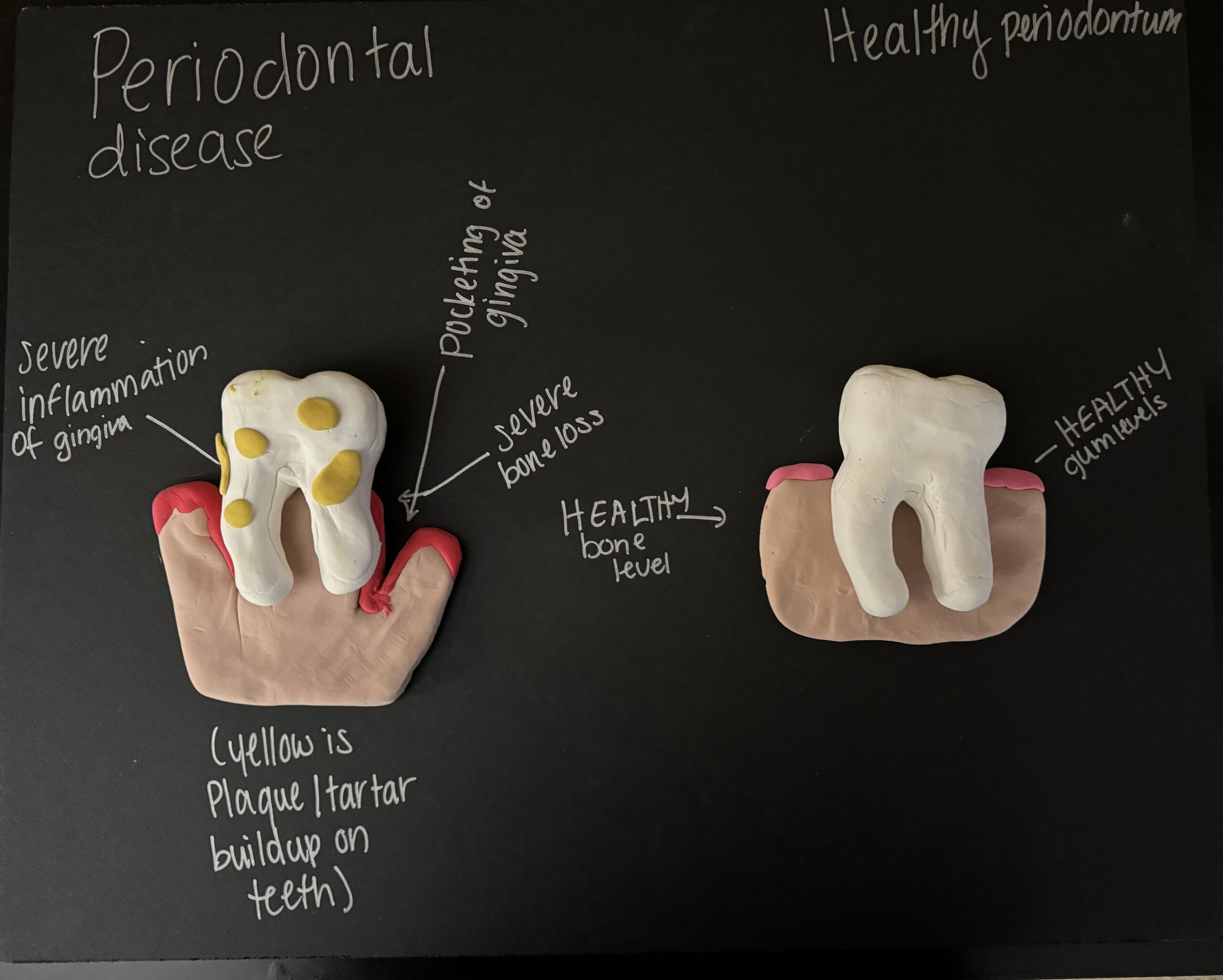 Periodontal disease (gum disease)