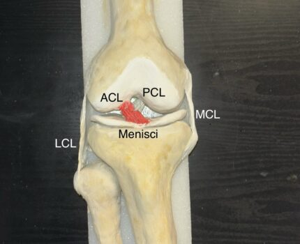 Anterior Cruciate Ligament tear