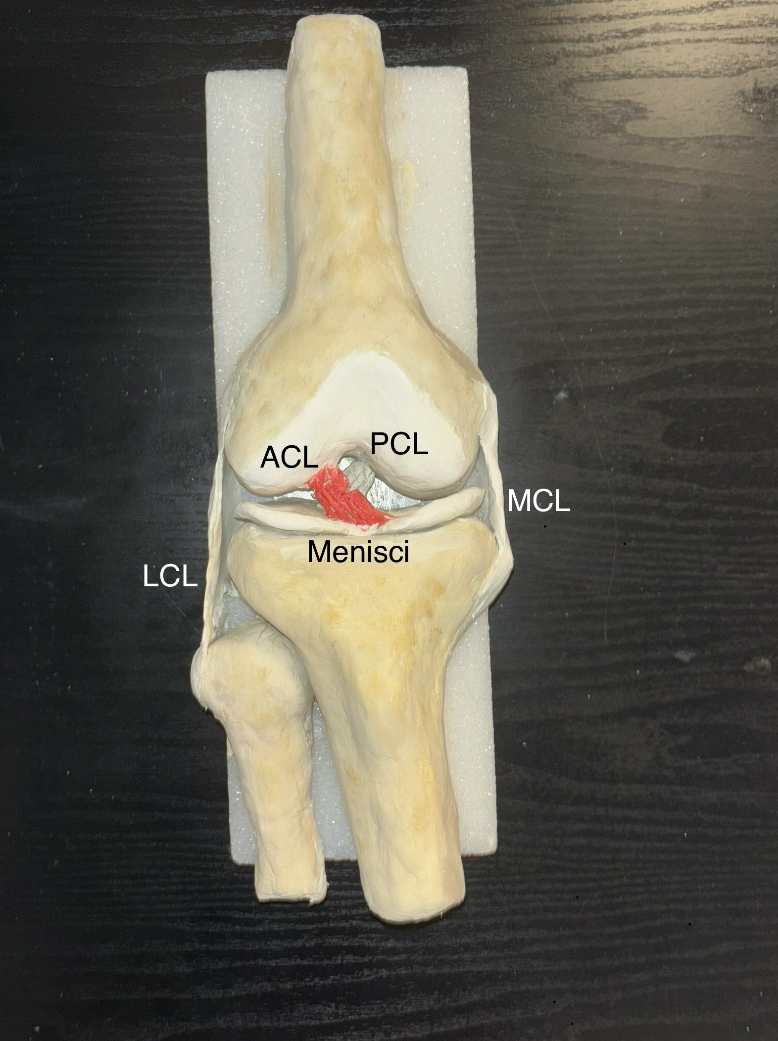 Anterior Cruciate Ligament tear