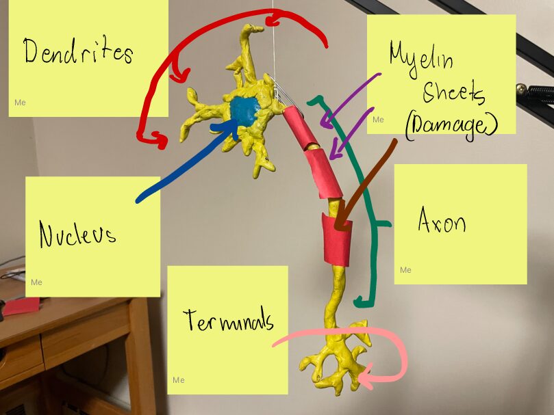 Multiple Sclerosis and how it impairs the Nervous System