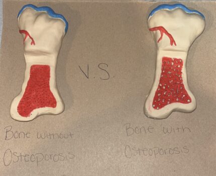 Osteoporosis in Pregnant Women