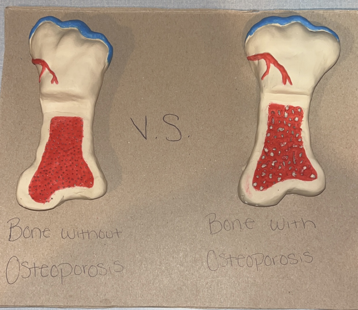 Osteoporosis in Pregnant Women