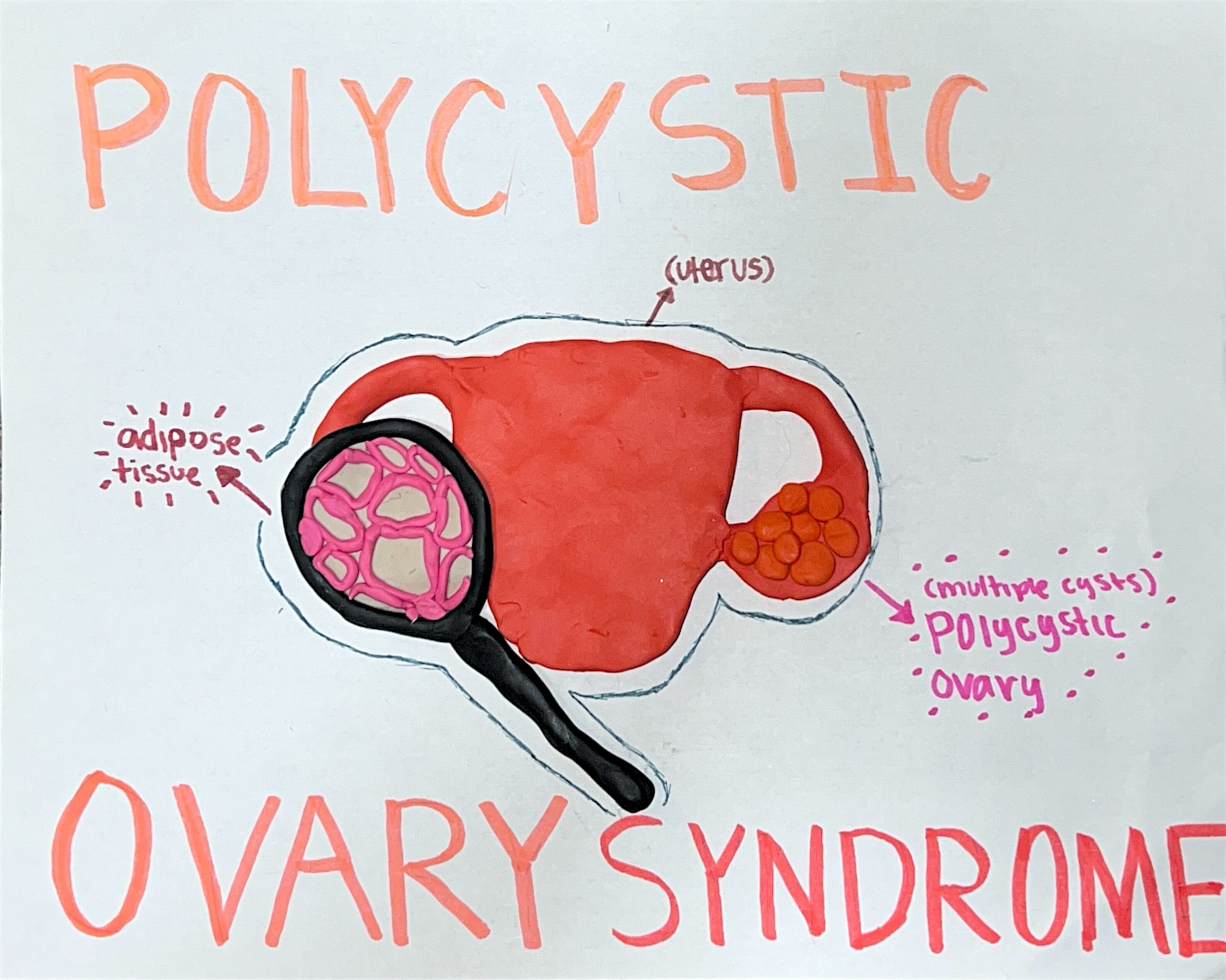 PCOS And Adipose Tissue