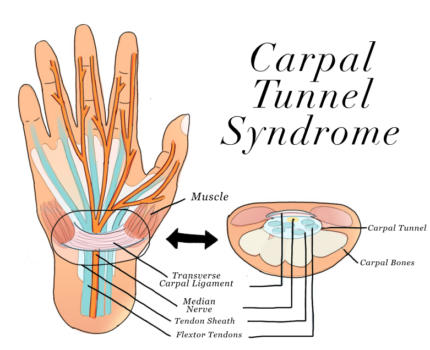 Carpal Tunnel Syndrome- Natasha Fenton